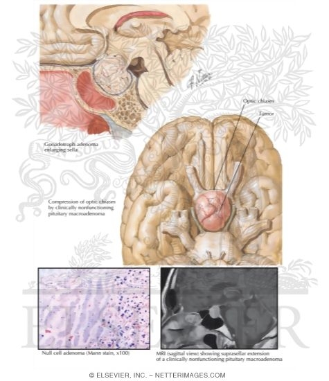 Watermarked preview of labeled image: Clinically Nonfunctioning Pituitary Tumor