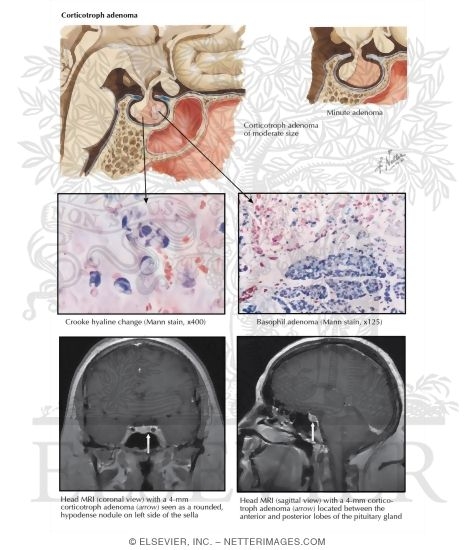 Watermarked preview of labeled image: Corticotropin-Secreting Pituitary Tumor