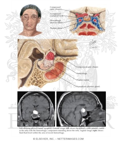 Pituitary Apoplexy