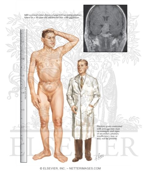 Pituitary Gigantism