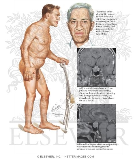Acromegaly