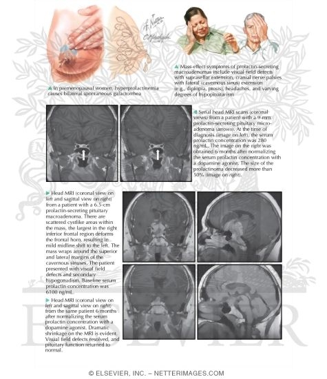 Watermarked preview of labeled image: Prolactin-Secreting Pituitary Tumor