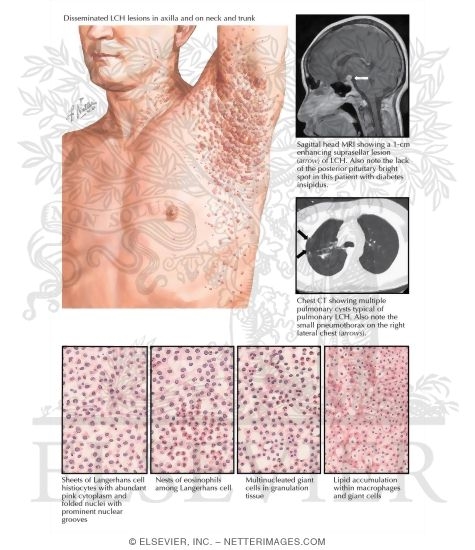Watermarked preview of labeled image: Langerhans Cell Histiocytosis in Adults
