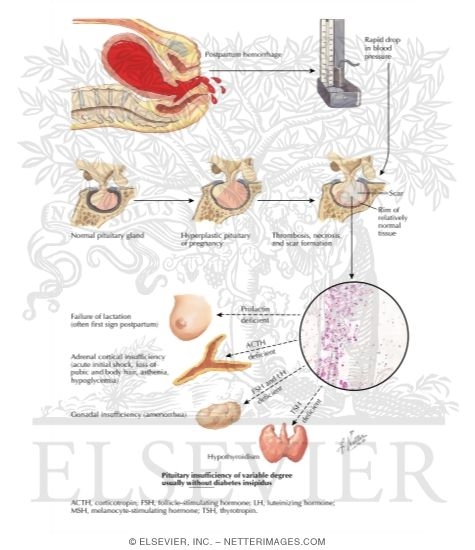 Watermarked preview of labeled image: Postpartum Pituitary Infarction (Sheehan Syndrome)