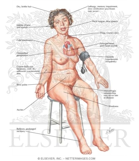 Watermarked preview of labeled image: Primary and Secondary Adult Myxedema
Hypothyroidism