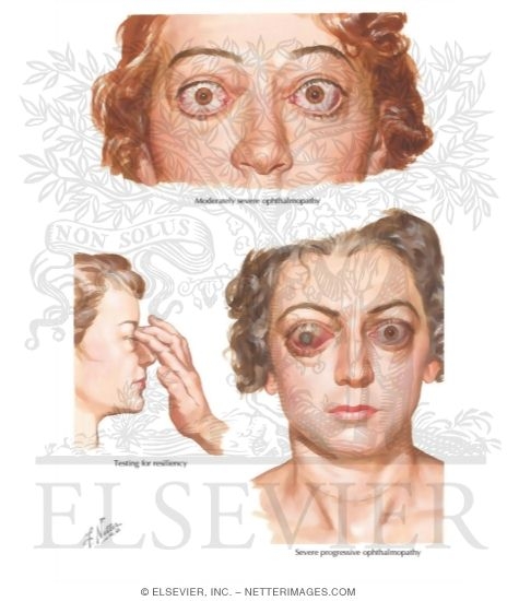 Graves Ophthalmopathy