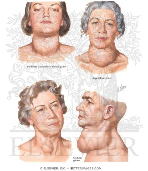 Watermarked preview of labeled image: Euthyroid Goiter