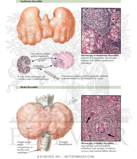 Watermarked preview of labeled image: Chronic Lymphocytic Thyroiditis and Fibrous Thyroiditis