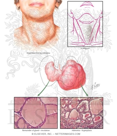 Watermarked preview of labeled image: Pathophysiology of Toxic Adenoma and Toxic Multinodular Goiter