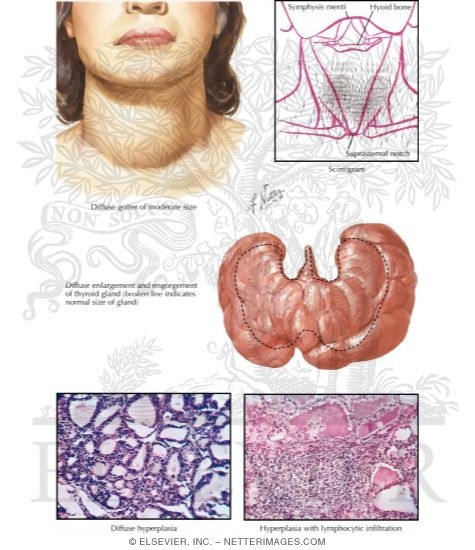 Thyroid Pathology in Graves Disease