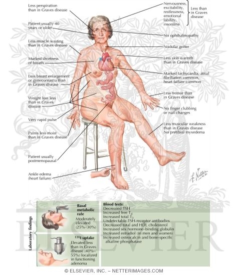 Clinical Manifestations of Toxic Adenoma and Toxic Multinodular Goiter