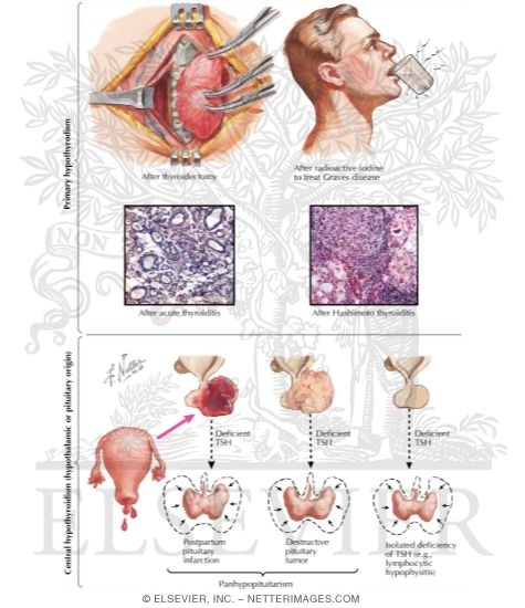 Watermarked preview of labeled image: Clinical Manifestations of Hypothyroidism in the Adult (Continued)