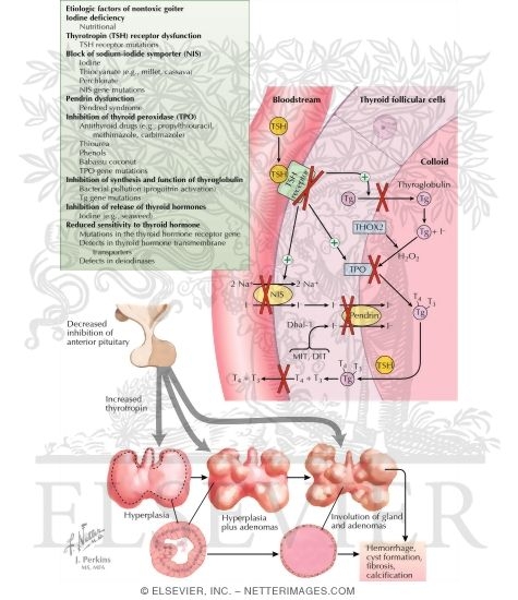Watermarked preview of labeled image: Etiology of Nontoxic Goiter