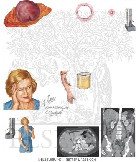 Pheochromocytoma and Paraganglioma