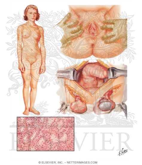 Watermarked preview of unlabeled image: Disorders of Sex Development