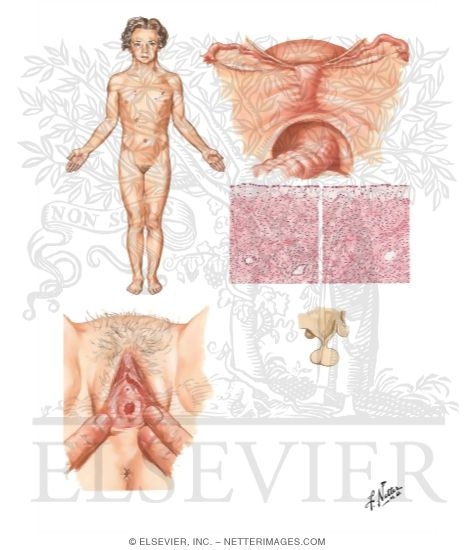 Turner Syndrome Gonadal Dysgenesis