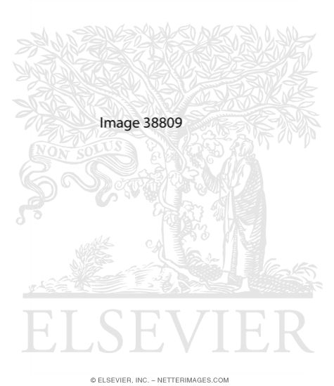 Watermarked preview of unlabeled image: Hirsutism and Virilization