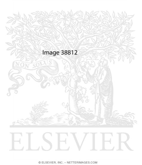 Watermarked preview of unlabeled image: Type 2 Diabetes Mellitus