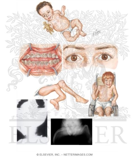 Osteogenesis Imperfecta