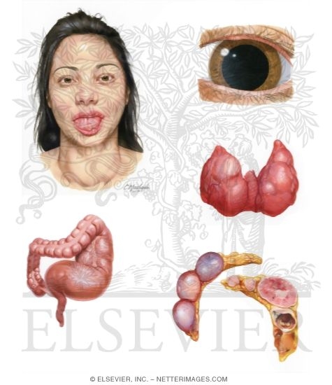 Multiple Endocrine Neoplasia Type 2 (Continued)