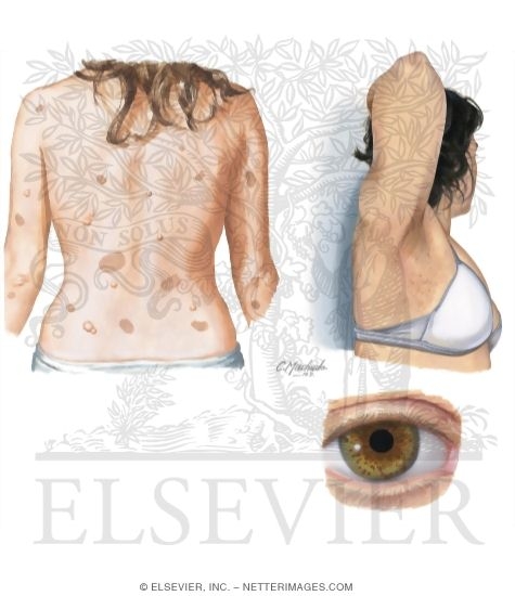 Neurofibromatosis Type 1 (Von Recklinghausen Disease)