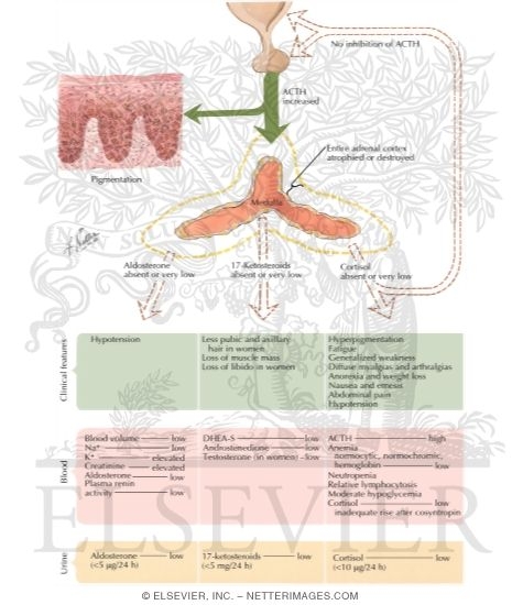Watermarked preview of labeled image: Laboratory Findings and Treatment in Primary Adrenal Insufficiency