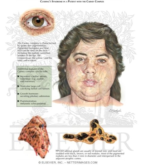 Carney Complex: Cushing's Syndrome Caused by Primary Pigmented Nodular Adrenocortical Disease
