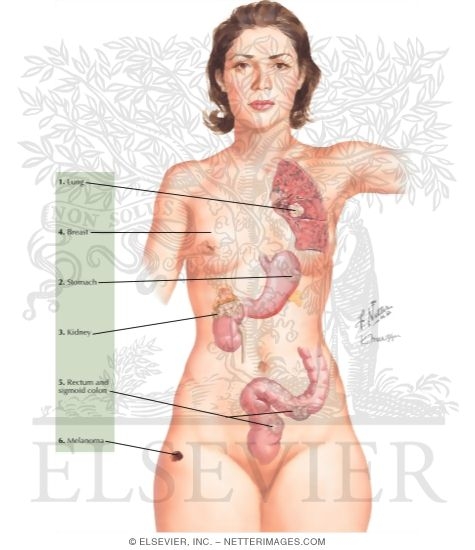 Watermarked preview of labeled image: Tumors Metastatic to the Adrenal Glands