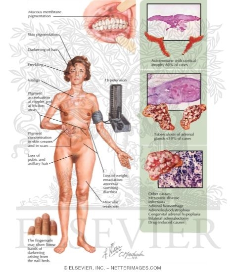 Watermarked preview of labeled image: Chronic Primary Adrenal Failure: Addison's Disease