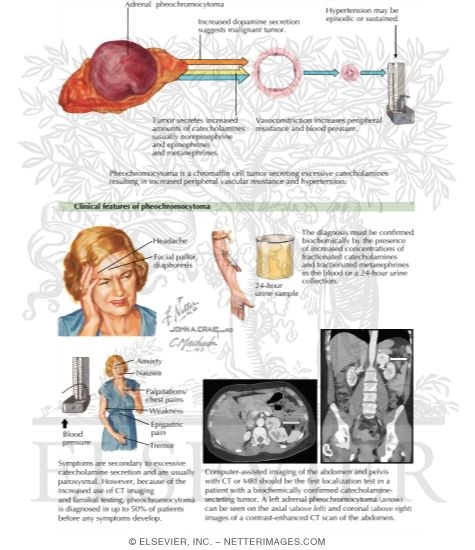 Pheochromocytoma and Paraganglioma