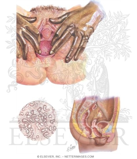 Intersex: Male Pseudohermaphroditism I - Gonadal
