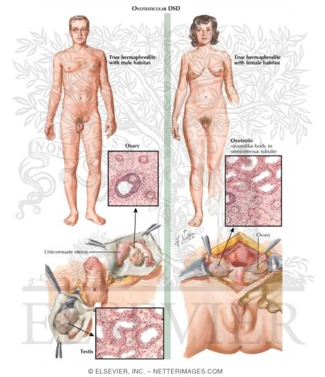 Watermarked preview of labeled image: Disorders of Sex Development (Continued)