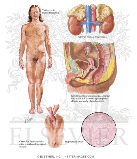 Female Pseudohermaphroditism