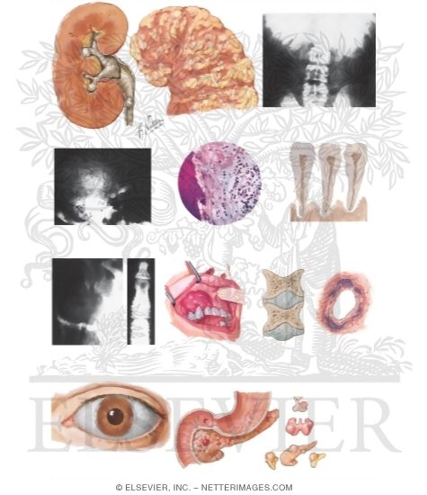 Watermarked preview of unlabeled image: Pathology and Clinical Manifestations of Primary Hyperparathyroidism