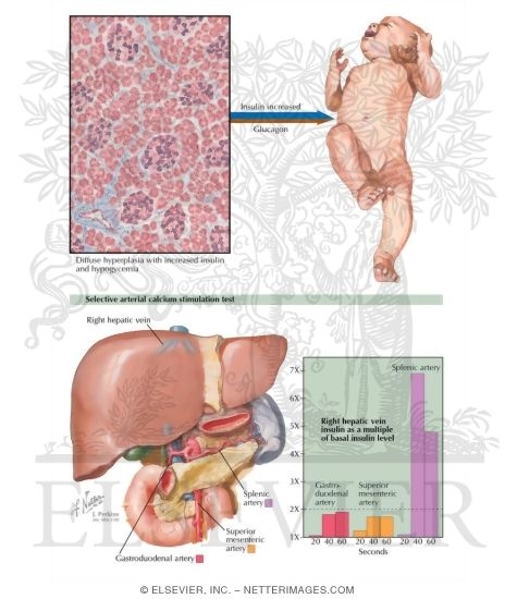 Watermarked preview of labeled image: Primary Pancreatic b-Cell Hyperplasia