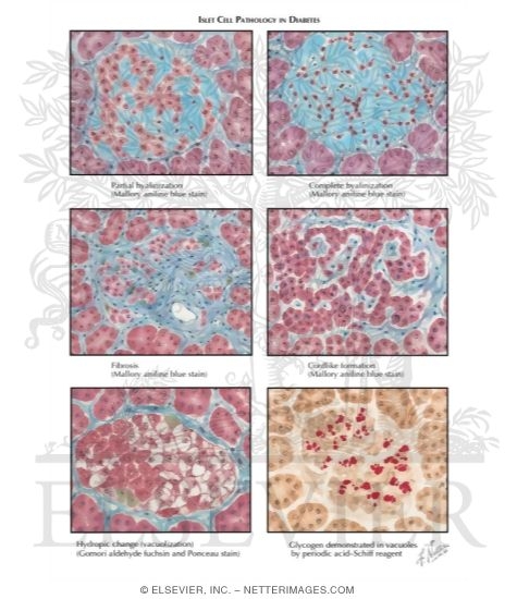 Watermarked preview of labeled image: Type 1 Diabetes Mellitus