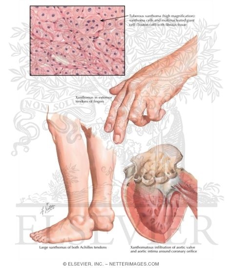 Hypercholesterolemic Xanthomatosis - Plain and Tuberous Xanthoma