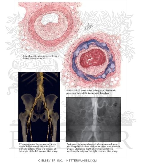 Watermarked preview of labeled image: Atherosclerosis in Diabetes