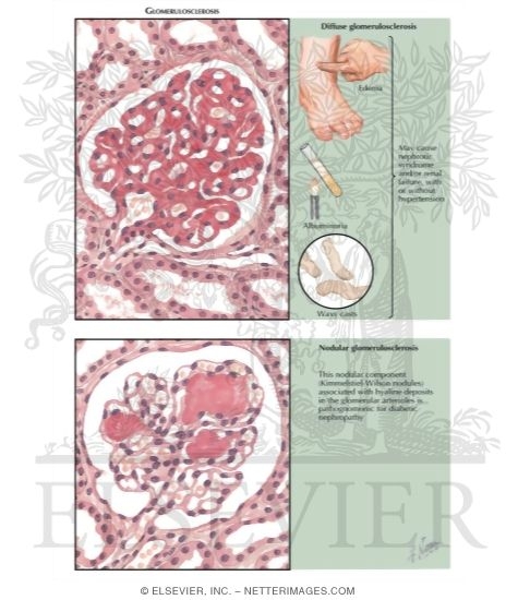 Watermarked preview of labeled image: Intercapillary Glomerulosclerosis