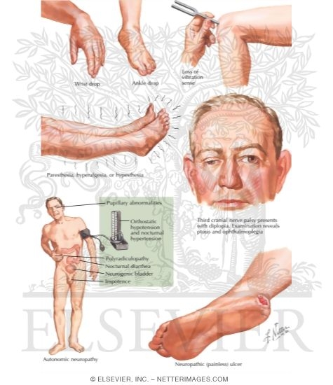 Watermarked preview of labeled image: Diabetic Neuropathy
