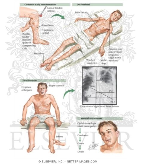 Vitamin B1 Deficiency: Beriberi