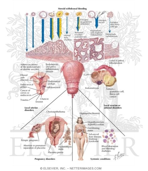 Watermarked preview of labeled image: Functional and Pathological Causes of Uterine Bleeding
Dysfunctional Uterine Bleeding