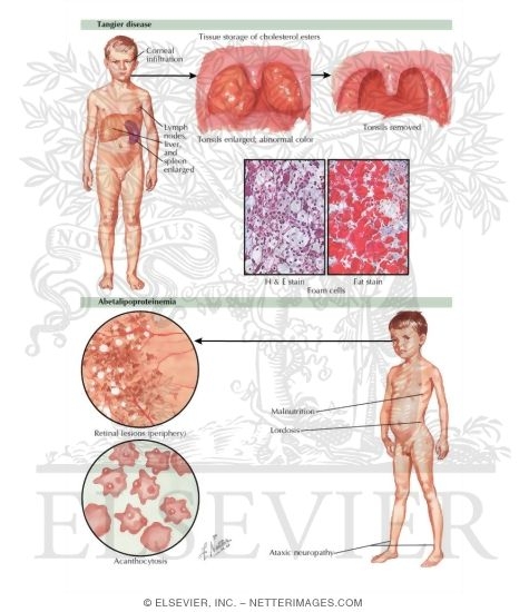 Abetalipoproteinemia and Tangier Disease