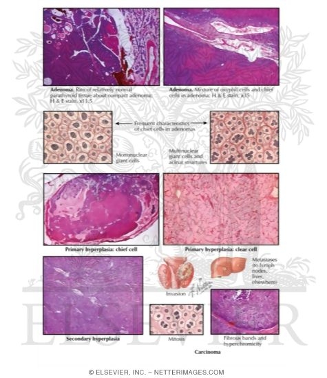Histology of the Parathyroid Glands in Hyperparathyroidism