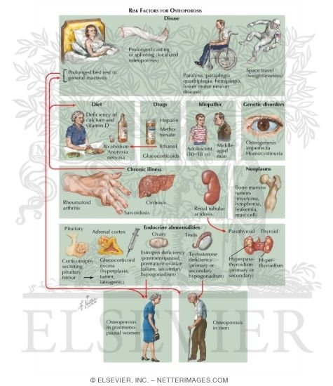 Watermarked preview of labeled image: Causes of Osteoporosis