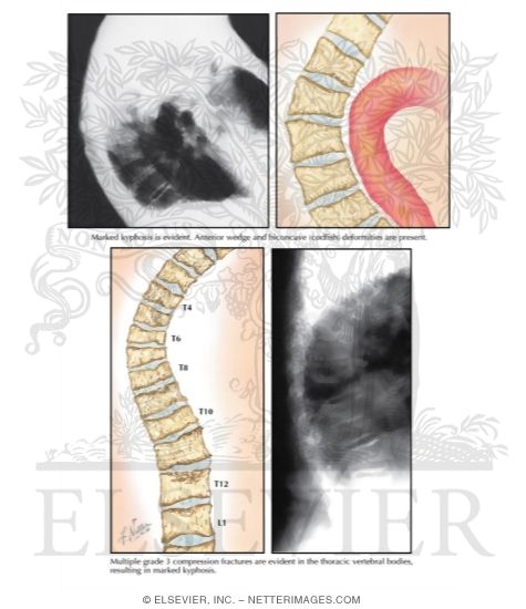 Watermarked preview of labeled image: Clinical Manifestations of Osteoporotic Vertebral Compression Fractures