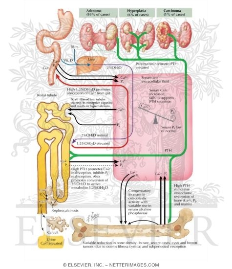 Watermarked preview of labeled image: Pathophysiology of Primary Hyperparathyroidism