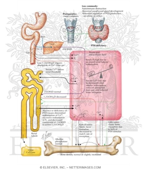 Watermarked preview of labeled image: Pathophysiology of Hypoparathyroidism