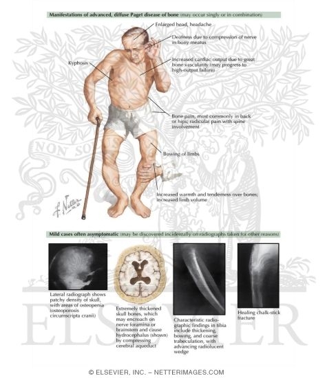 Paget's Disease of the Bone
