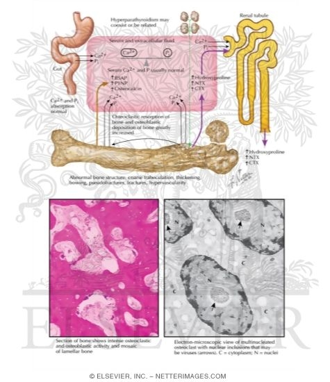 Watermarked preview of labeled image: Pathogenesis and Treatment of Paget's Disease of the Bone